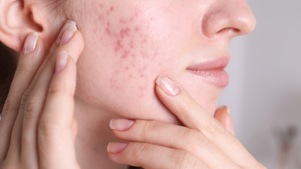 Acne mild