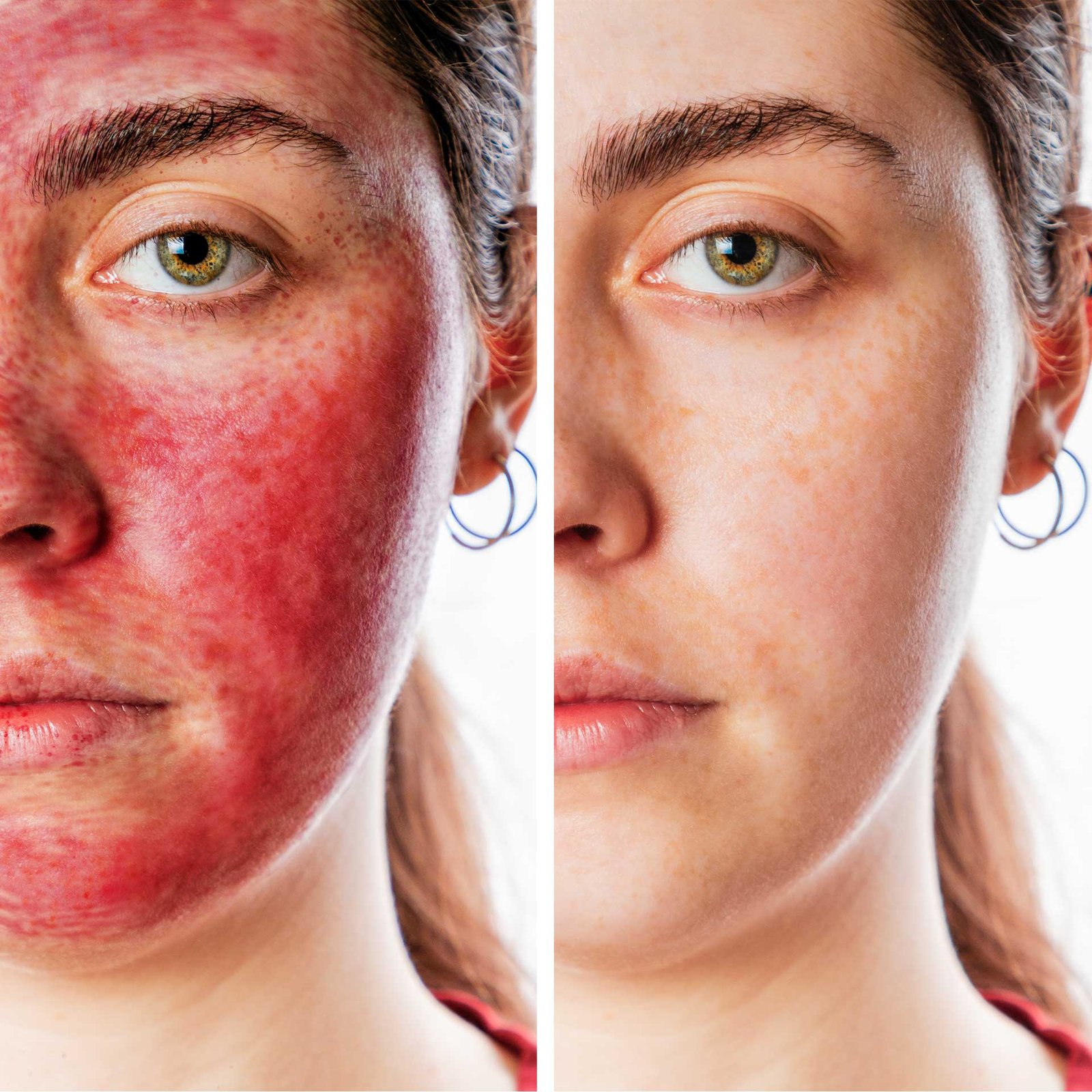 artemedica bna vampire facial