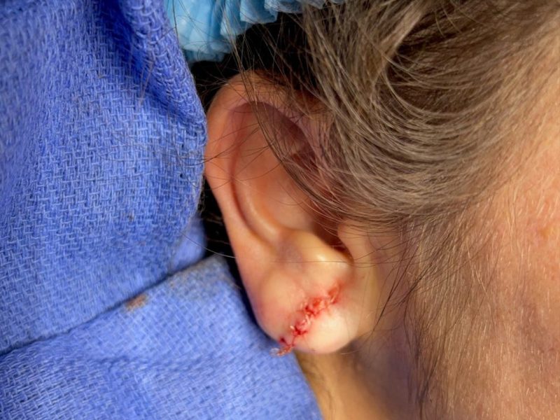 Earlobe-Repair-Surgery-1
