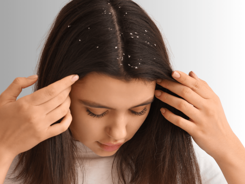 Say-Goodbye-to-Dandruff