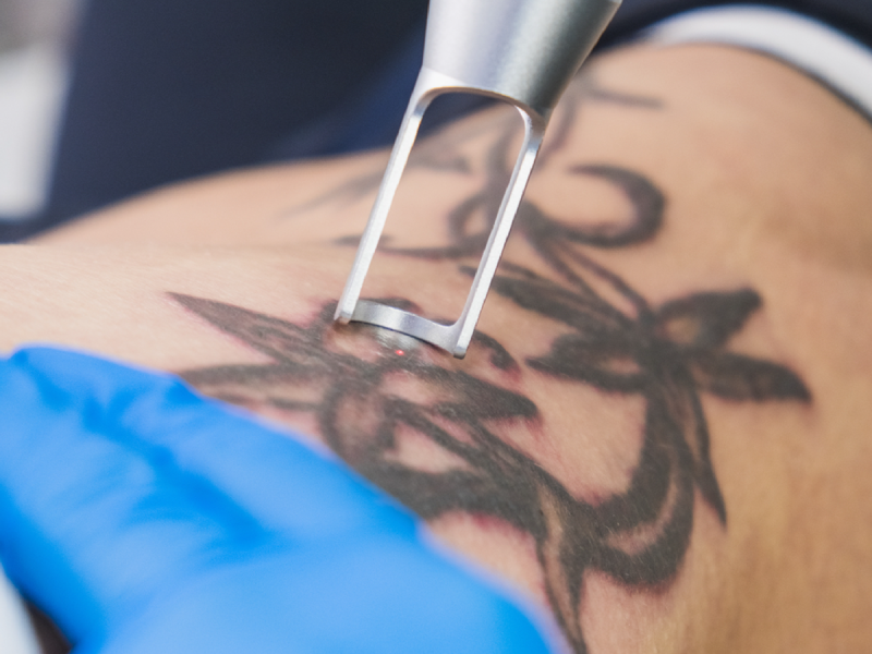 Tattoo Removal CU_1600x900