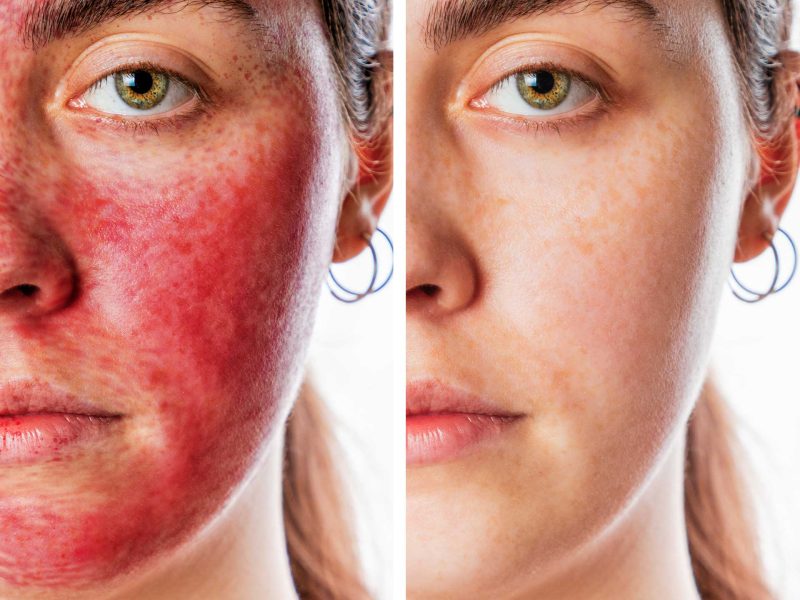 artemedica_bna_vampire-facial