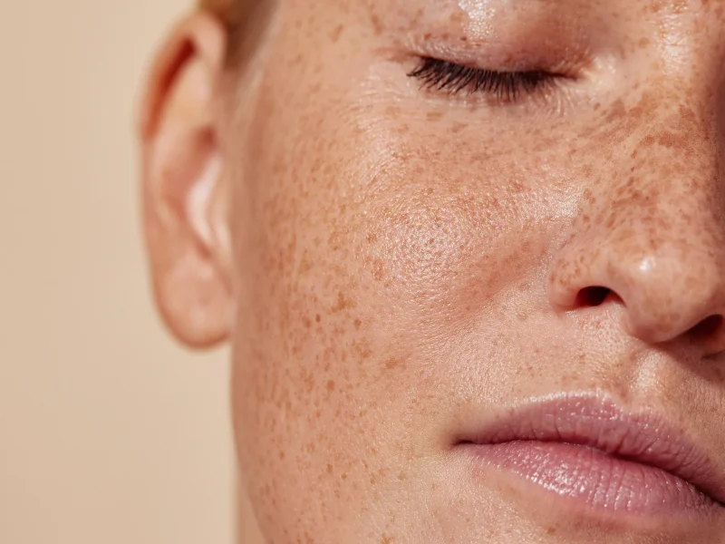 bcn_clinc_manchas_piel_texto_3