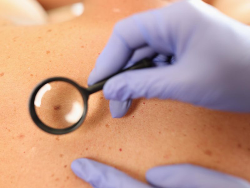 gloved-doctor-dermatologist-with-magnifying-glass-examines-skin-patient