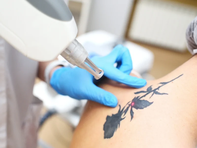 guide-to-laser-tattoo-removal-scaled-3 (1)