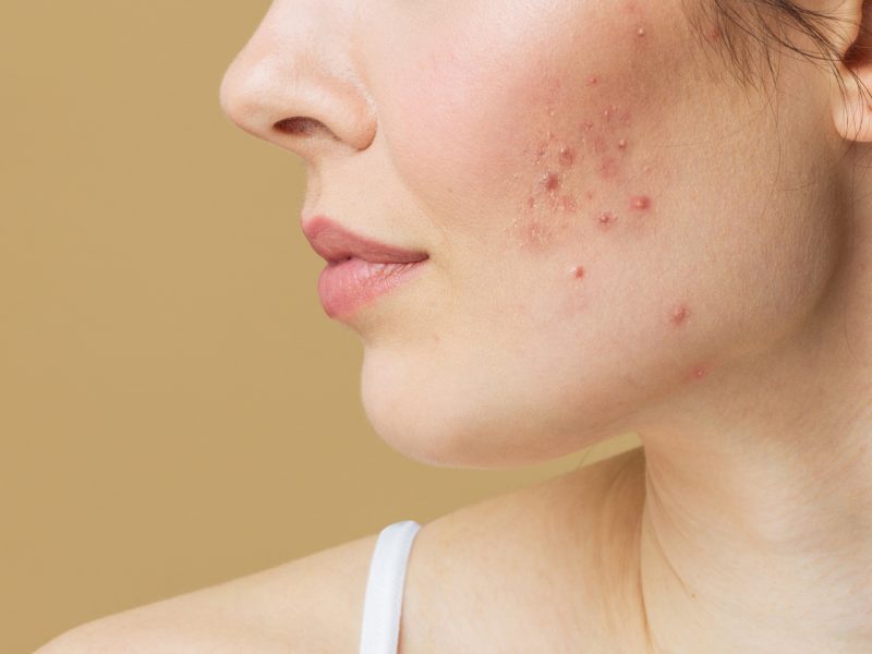 Young woman before and after acne treatment. Skin care concept