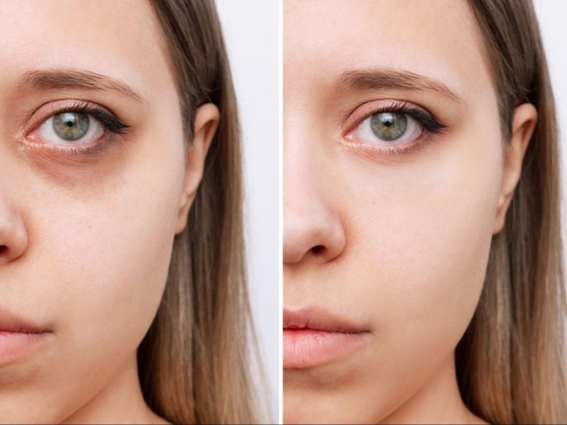 non-surgical-eye-lift-treatmen