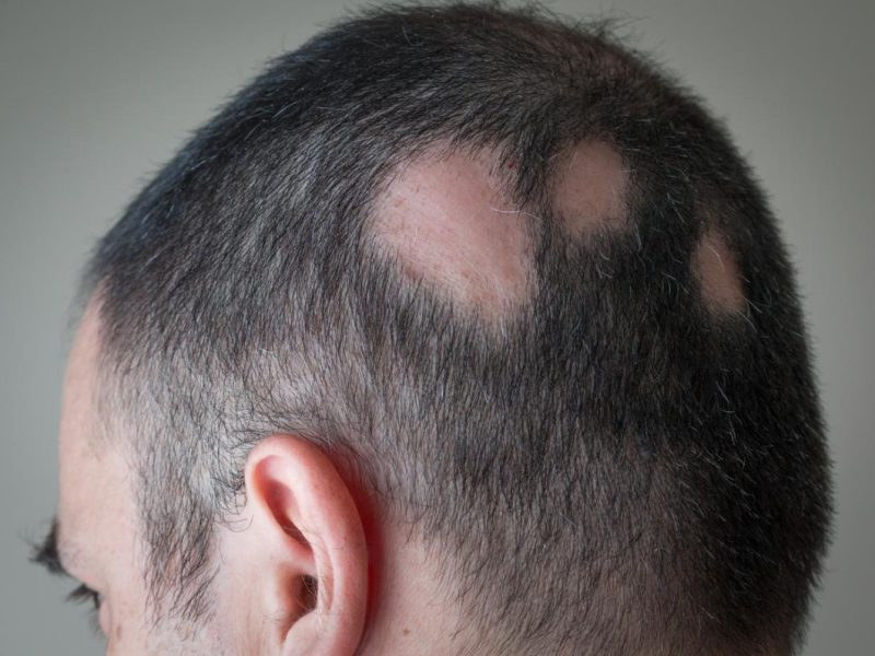partial-alopecia (1)