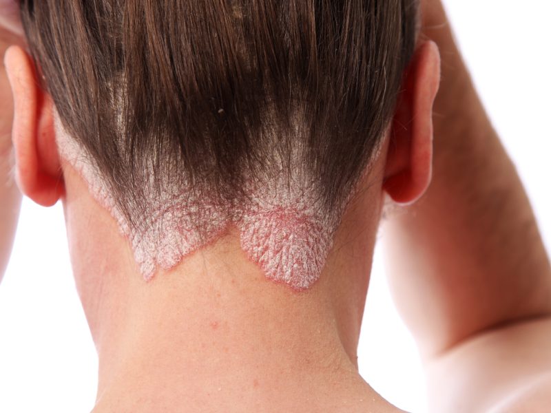 psoriasis on the hairline and on the scalp-close up
