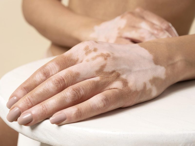 young-woman-with-vitiligo-posing-scaled